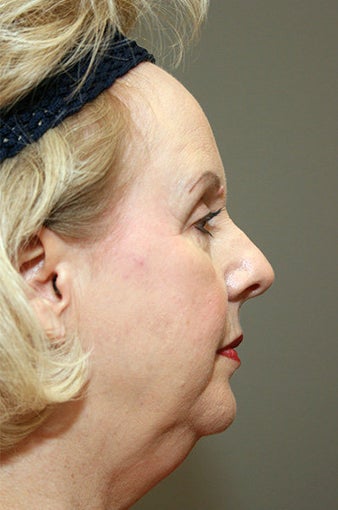 Chin Implant