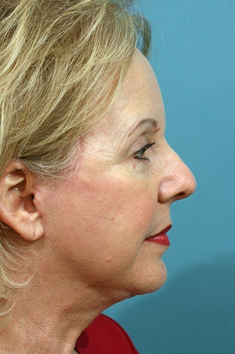 Chin Implant