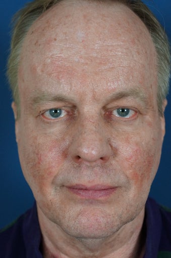 Man in 50's seek non-surgical facial rejuvention