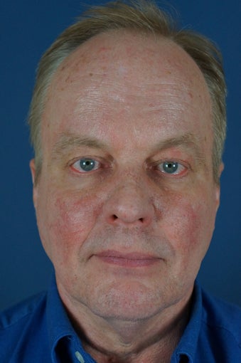 Man in 50's seek non-surgical facial rejuvention
