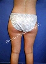 Liposuction