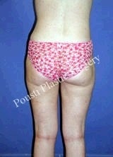 Liposuction