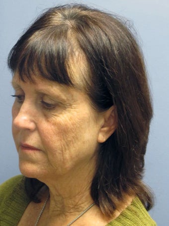 Neck Lift, Platysmaplasty