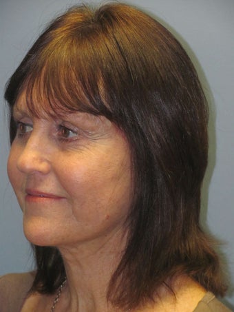 Neck Lift, Platysmaplasty