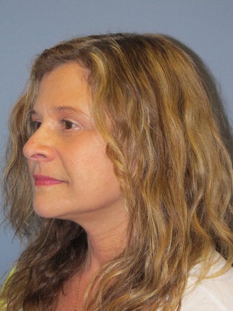 Neck Lift, Platysmaplasty