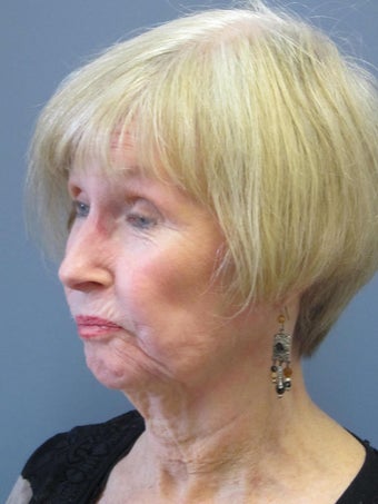 Neck Lift, Platysmaplasty