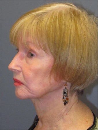 Neck Lift, Platysmaplasty