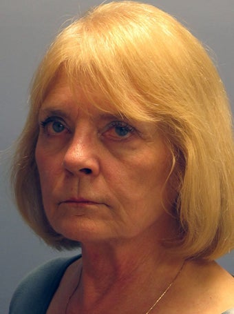 Neck Lift, Platysmaplasty