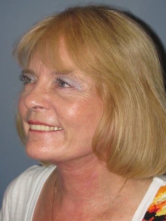 Neck Lift, Platysmaplasty