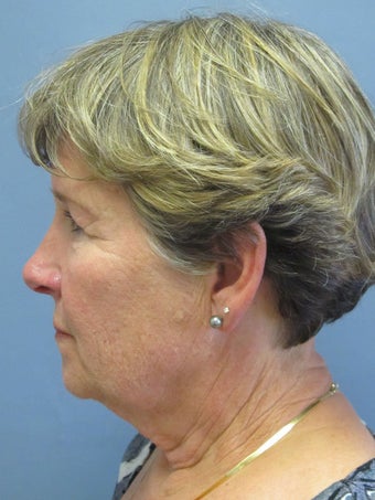 Neck Lift, Platysmaplasty