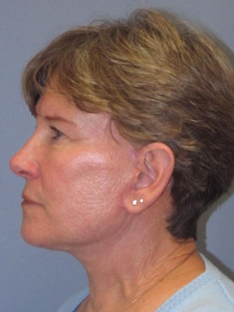 Neck Lift, Platysmaplasty