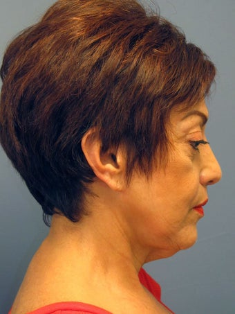 Neck Lift, Platysmaplasty