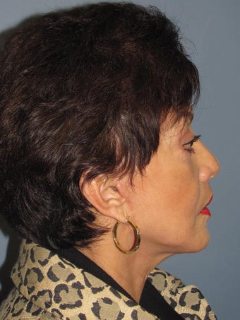Neck Lift, Platysmaplasty