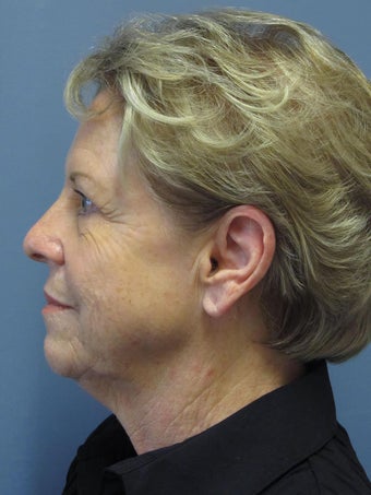 Neck Lift, Platysmaplasty