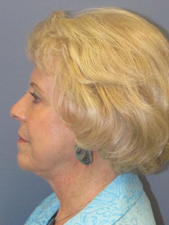 Neck Lift, Platysmaplasty