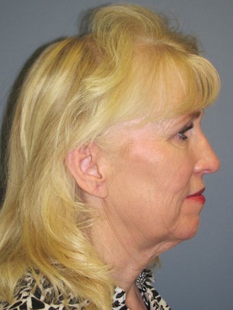 Neck Lift, Platysmaplasty