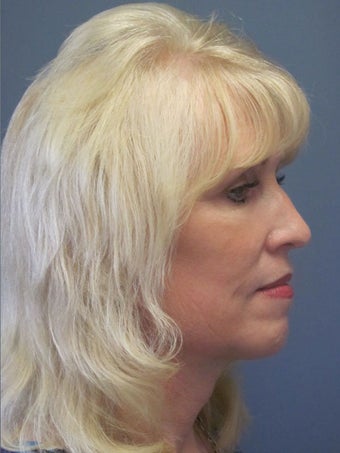 Neck Lift, Platysmaplasty