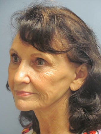 Obagi Blue Peel