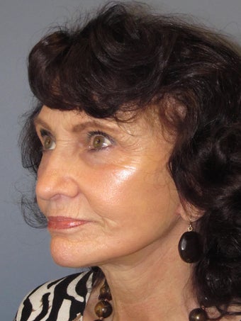 Obagi Blue Peel