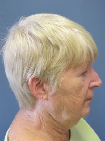 Obagi Blue Peel