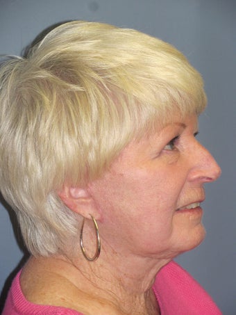 Obagi Blue Peel