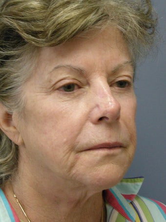 Obagi Blue Peel