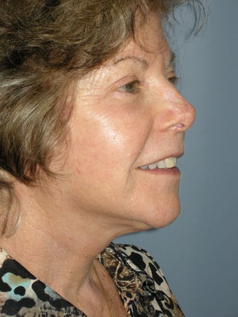 Obagi Blue Peel