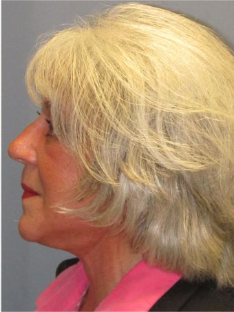 Obagi Blue Peel
