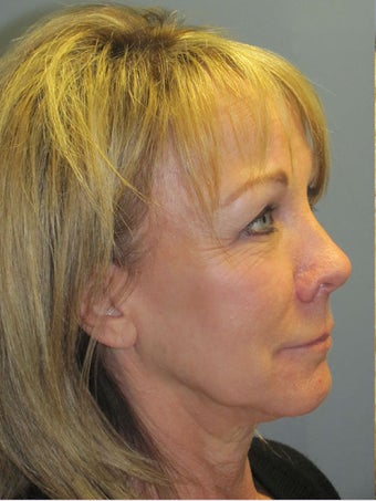 Obagi Blue Peel
