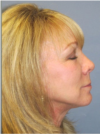 Obagi Blue Peel