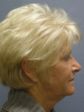 Obagi Blue Peel