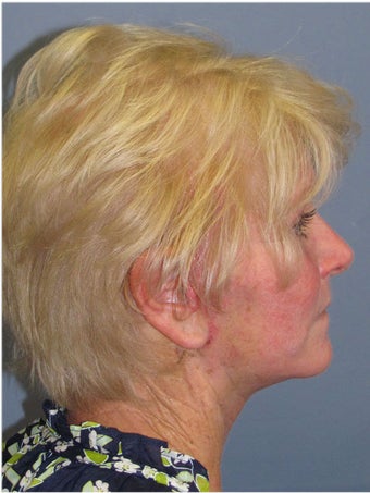 Obagi Blue Peel