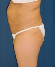 Brazilian Butt Lift