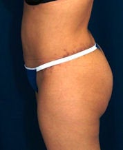 Brazilian Butt Lift