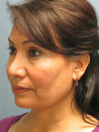 Chin Augmentation