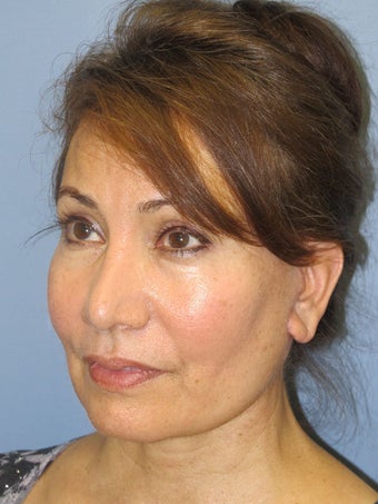 Chin Augmentation