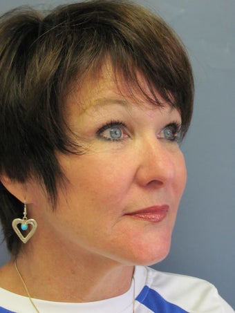 Chin Augmentation