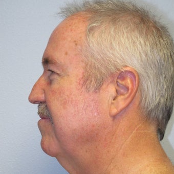 Necklift