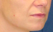 Lift Lip