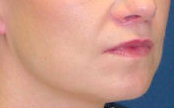 Lift Lip