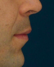 Lip Lift 