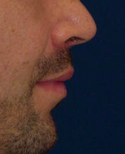Lip Lift 