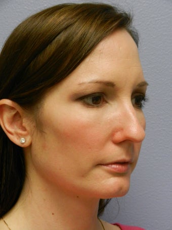 Before and After Skin Care