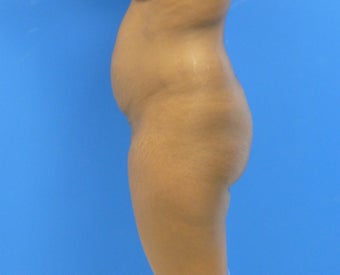Brazilian Butt Lift - via Fat transfer
