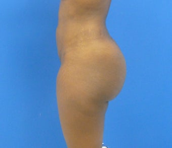 Brazilian Butt Lift - via Fat transfer