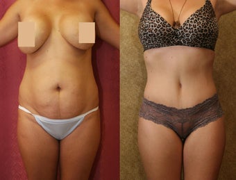 tummy tuck