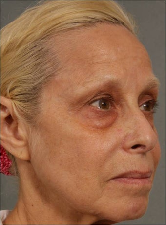 60 Year Old Female treated for under eye puffiness, sagging cheeks and frown lines non surgically
