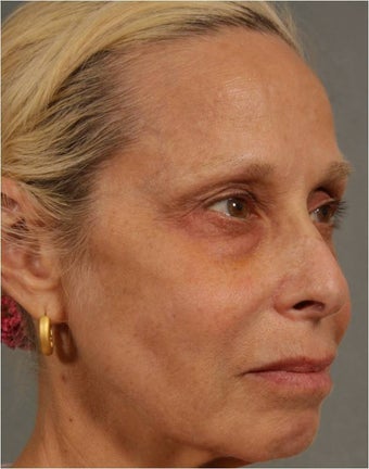 60 Year Old Female treated for under eye puffiness, sagging cheeks and frown lines non surgically