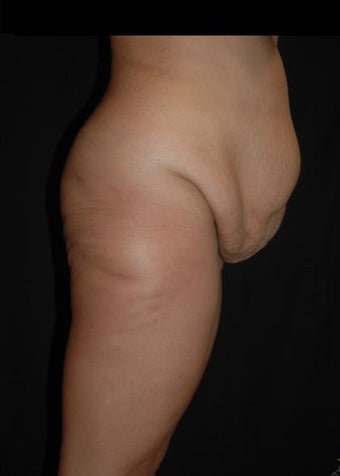 29 year old female treated for excess skin and weight.