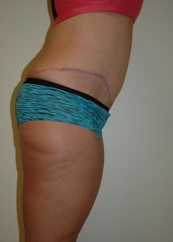 29 year old female treated for excess skin and weight.